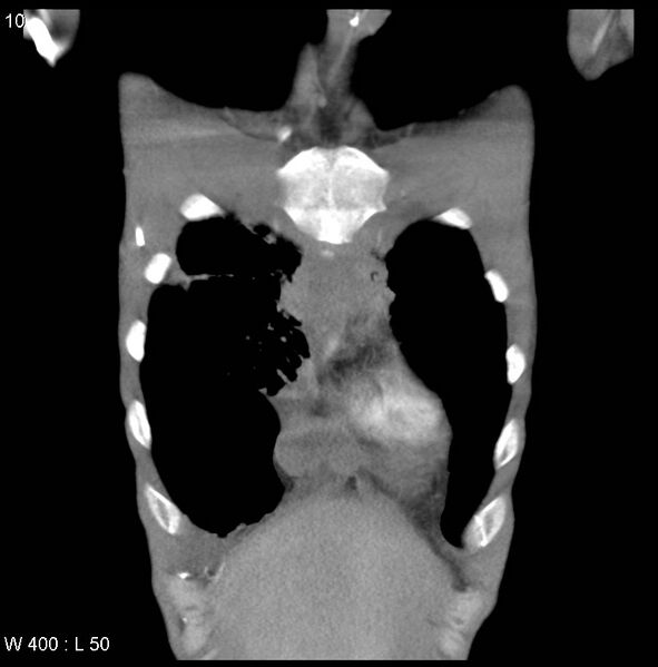 File:Non-Hodgkin lymphoma involving lung (Radiopaedia 29094-29470 C 4).jpg