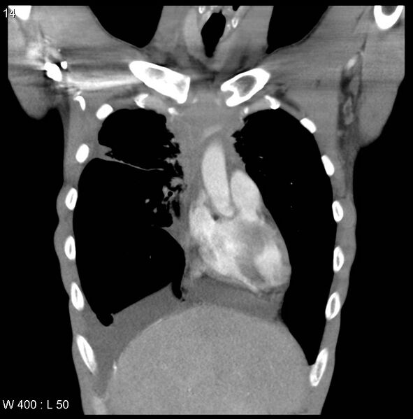 File:Non-Hodgkin lymphoma involving lung (Radiopaedia 29094-29470 C 8).jpg