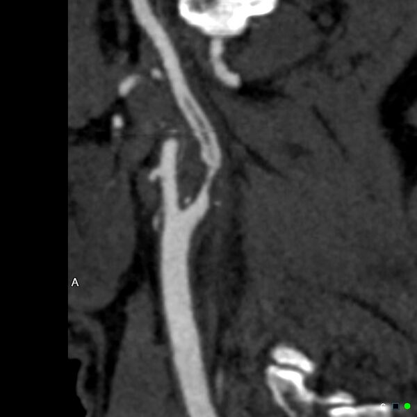 File:Non-occlusive intraluminal internal carotid artery thrombus (Radiopaedia 37751-39658 A 55).jpg