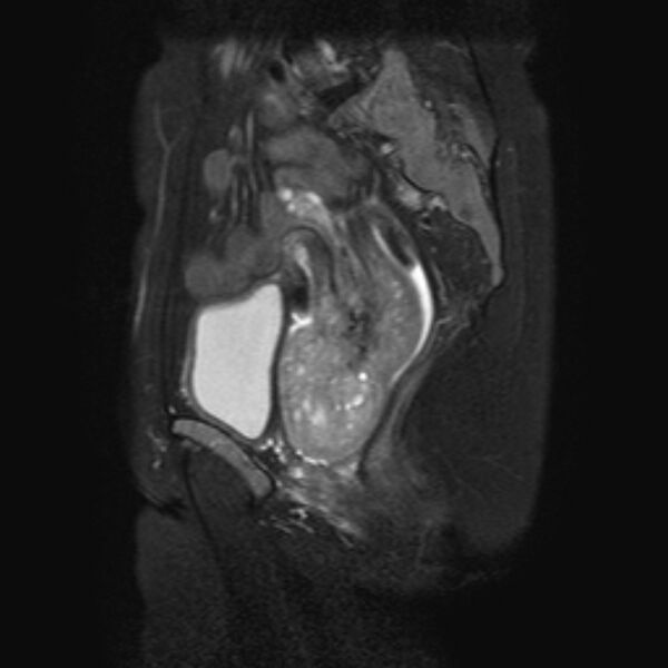 File:Non-puerperal uterine inversion (Radiopaedia 78343-90983 Sagittal T2 fat sat 13).jpg