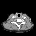 Normal CT of the neck (Radiopaedia 14575-14500 Axial C+ 49).jpg