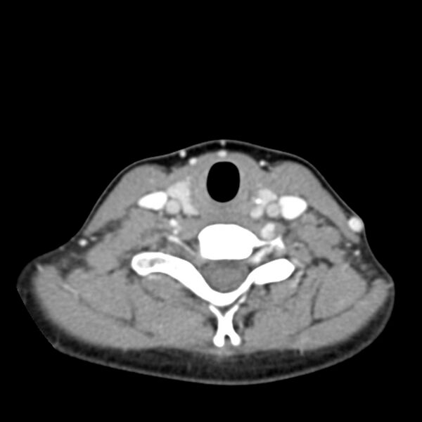 File:Normal CT of the neck (Radiopaedia 14575-14500 Axial C+ 49).jpg