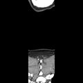 Normal CT of the neck (Radiopaedia 14575-14500 Coronal C+ 55).jpg