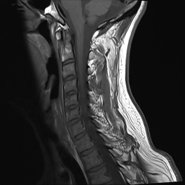 File:Normal MRI cervical spine (infection protocol) (Radiopaedia 53916-60039 Sagittal T1 9).png