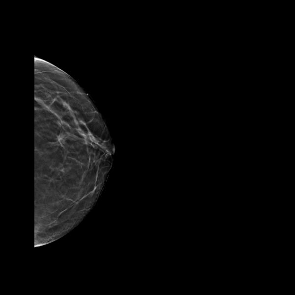 File:Normal breast mammography (tomosynthesis) and ultrasound (Radiopaedia 65325-74353 LCC Tomo 18).jpeg