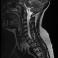 Normal cervical and thoracic spine MRI (Radiopaedia 35630-37156 Sagittal T2 4).png