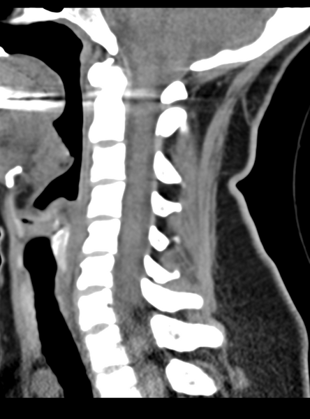 File:Normal cervical spine MRI (including Dixon) (Radiopaedia 42762-45926 C 33).png