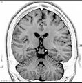 Normal coronal brain (Radiopaedia 6676-7910 B 28).jpg