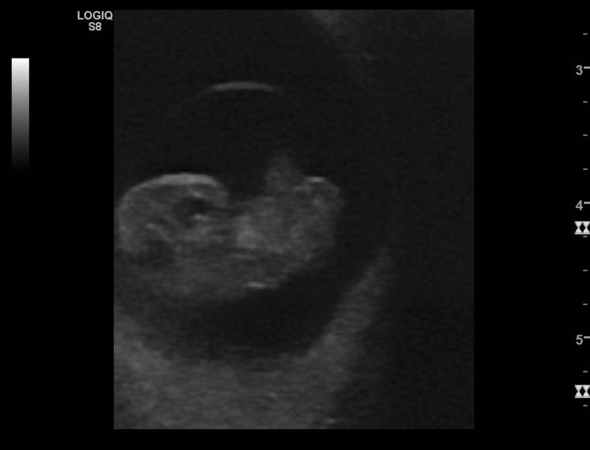 Normal early pregnancy - 8w0d (Radiopaedia 44715-48492 Longitudinal 34).jpg