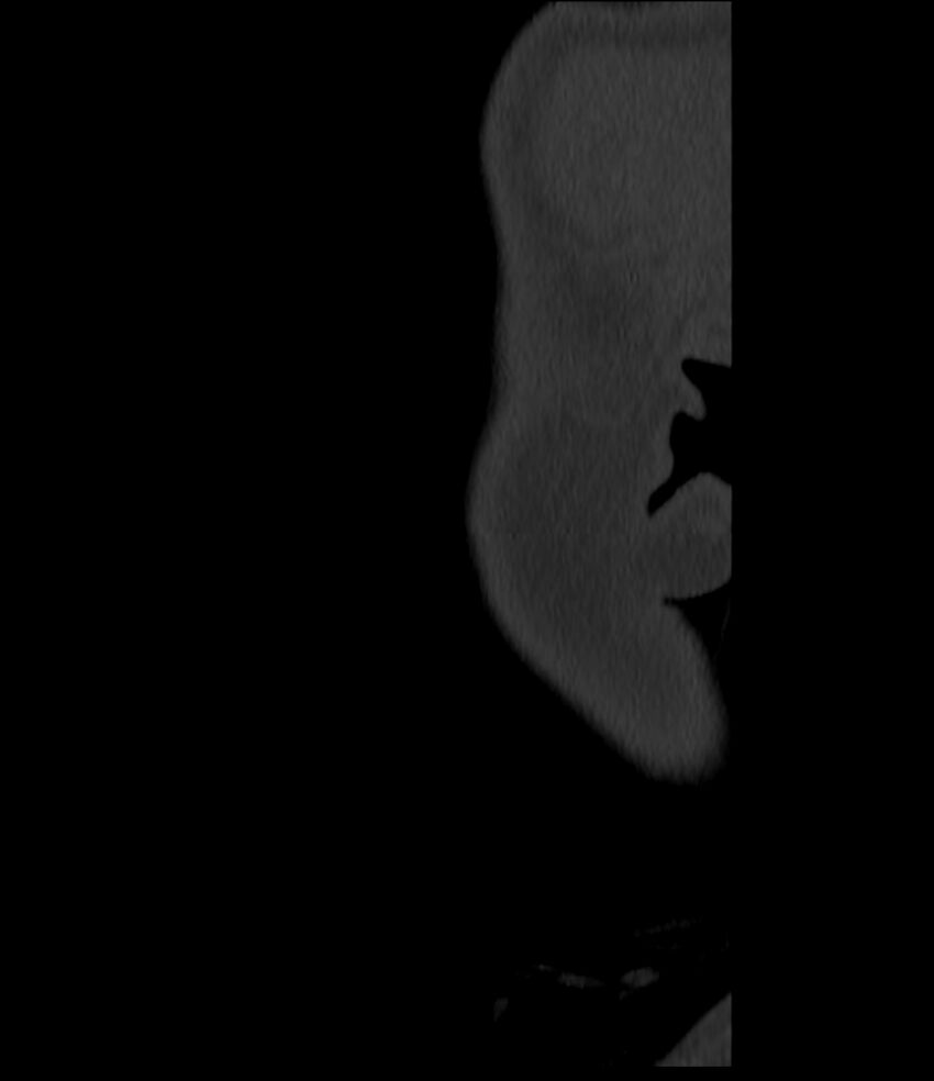 Normal facial bone CT (Radiopaedia 88742-105476 Sagittal bone window 163).jpg