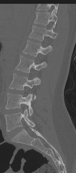 File:Normal lumbosacral CT (Radiopaedia 37923-39867 Sagittal bone window 59).png
