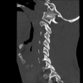 Normal trauma cervical spine (Radiopaedia 41017-43760 Sagittal bone window 11).png