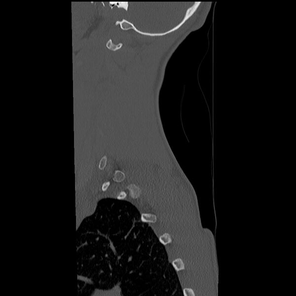 File:Normal trauma spine imaging (age 16) (Radiopaedia 45335-49358 Sagittal bone window 36).jpg