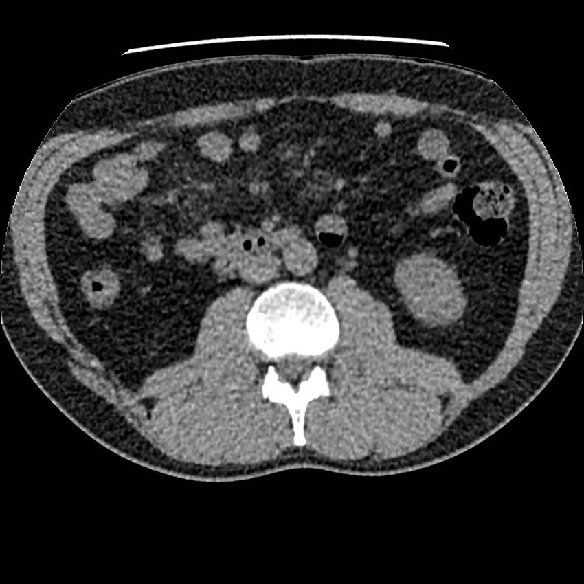 Obstructing ureteric calculus and ureteric anatomy (Radiopaedia 62730-71042 Axial non-contrast 59).jpg
