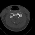 Occipital condyle fracture (Radiopaedia 31755-32691 Axial bone window 37).jpg