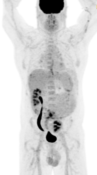 File:Pelvic kidney (Radiopaedia 29908).png