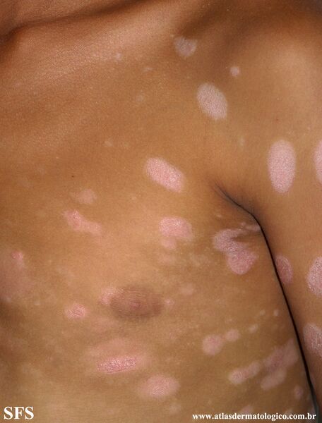File:Psoriasis (Dermatology Atlas 86).jpg
