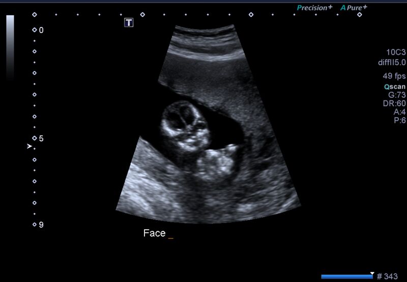 File:1st trimester nuchal-morphology ultrasound (Radiopaedia 44706-48477 General anatomy and NT 14).jpg