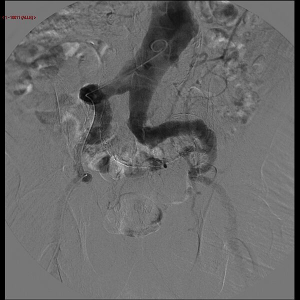 File:Abdominal aortic aneurysm (Radiopaedia 16155-15833 Frontal Aorta 7).jpg