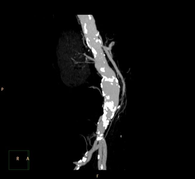 File:Abdominal aortic aneurysm (Radiopaedia 23703-23856 MIP 7).jpg