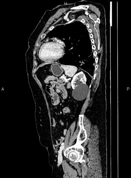 File:Abdominal aortic aneurysm (Radiopaedia 85063-100606 Sagittal C+ arterial phase 62).jpg