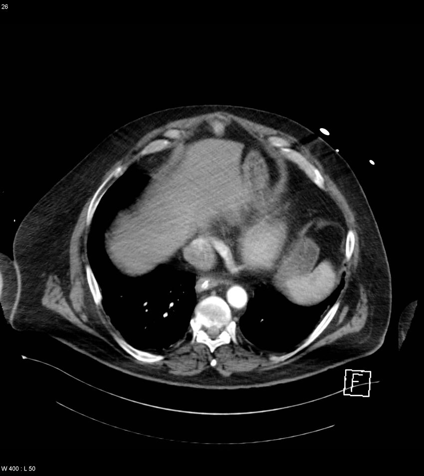 Abdominal aortic aneurysm with intramural hematoma then rupture (Radiopaedia 50278-55632 Axial C+ arterial phase 25).jpg