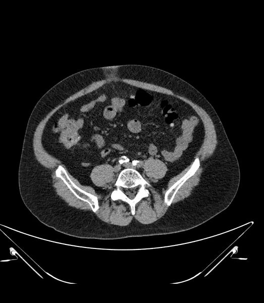 File:Abdominal aortic aneurysm with thrombus fissuration (Radiopaedia 46218-50618 Axial non-contrast 37).jpg
