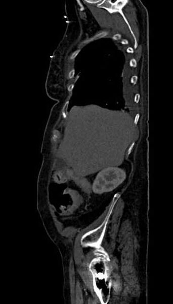 File:Abdominal aortic aneurysm with thrombus fissuration (Radiopaedia 73192-83919 Sagittal C+ arterial phase 119).jpg