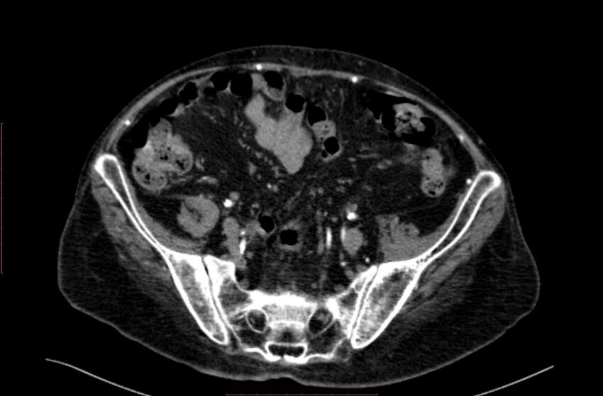 Abdominal aortic interposition tube graft and aneurysm thrombosis (Radiopaedia 71438-81857 Axial C+ arterial phase 168).jpg