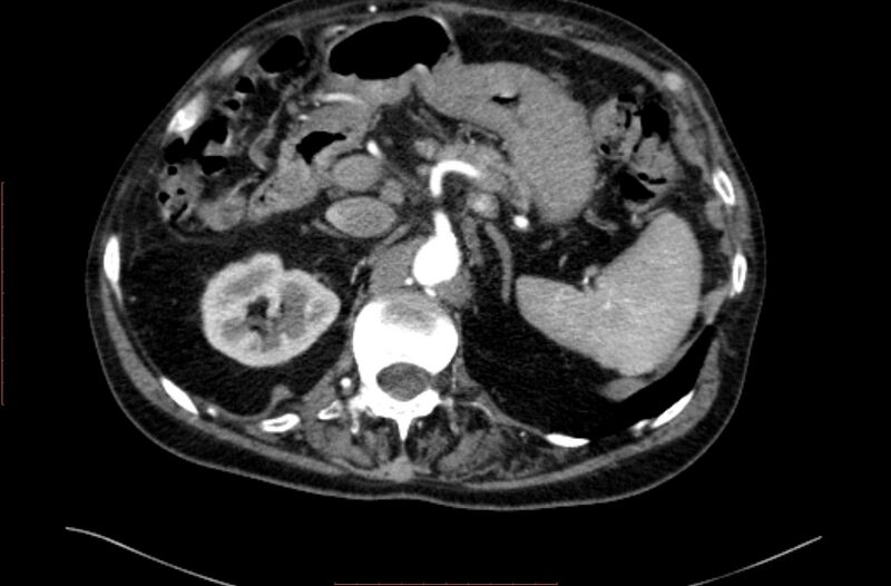 File:Abdominal aortic interposition tube graft and aneurysm thrombosis (Radiopaedia 71438-81857 Axial C+ arterial phase 22).jpg