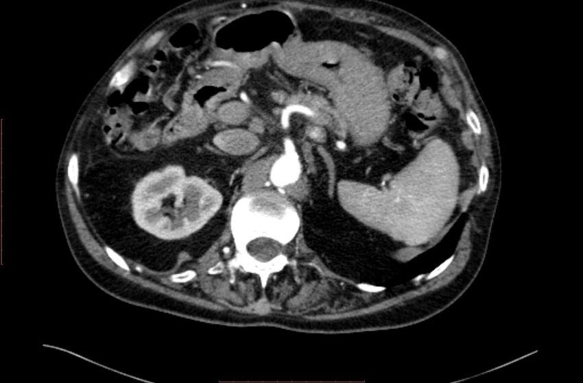 Abdominal aortic interposition tube graft and aneurysm thrombosis (Radiopaedia 71438-81857 Axial C+ arterial phase 22).jpg