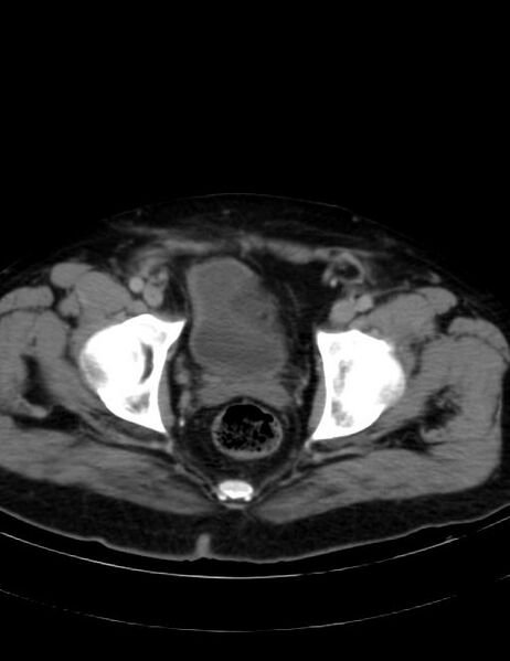 File:Abdominal lymphoma - with sandwich sign (Radiopaedia 53486-59492 Axial C+ portal venous phase 47).jpg