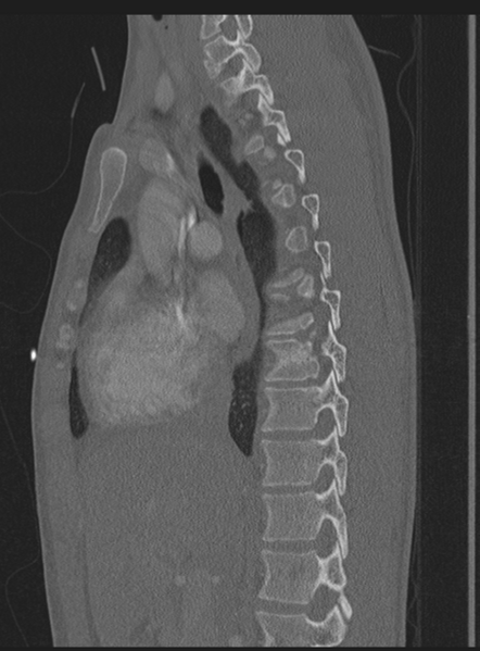 File:Abdominal multi-trauma - devascularised kidney and liver, spleen and pancreatic lacerations (Radiopaedia 34984-36486 Sagittal bone window 42).png
