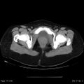 Abdominal wall endometriosis (Radiopaedia 25723-25885 Axial C+ portal venous phase 37).jpg