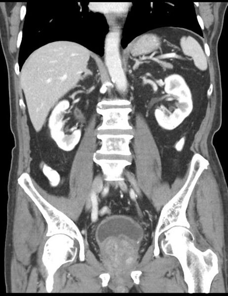 File:Abdominal wall metastasis from colorectal carcinoma (Radiopaedia 31016-31717 Coronal C+ portal venous phase 28).jpg