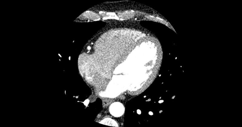 File:Aberrant left main coronary artery (ALMCA) arising from the right sinus with interarterial course (Radiopaedia 63251-71814 Axial C+ arterial phase 118).JPG