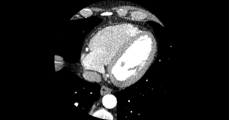 File:Aberrant left main coronary artery (ALMCA) arising from the right sinus with interarterial course (Radiopaedia 63251-71814 Axial C+ arterial phase 149).JPG