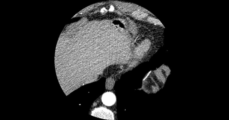 File:Aberrant left main coronary artery (ALMCA) arising from the right sinus with interarterial course (Radiopaedia 63251-71814 Axial C+ arterial phase 186).JPG