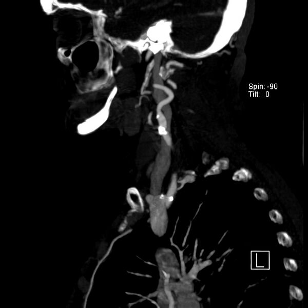 File:Aberrant right subclavian artery (Radiopaedia 22395-22430 Sagittal C+ arterial phase 14).jpg