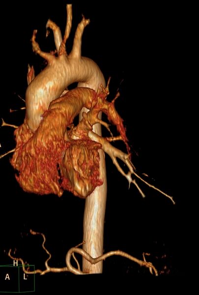 File:Aberrant right subclavian artery (Radiopaedia 67135-76475 B 13).jpg