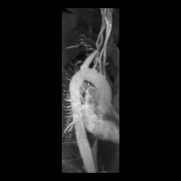 File:Aberrant right subclavian artery with background Takayasu arteritis (Radiopaedia 21423-21363 MRA 12).jpg