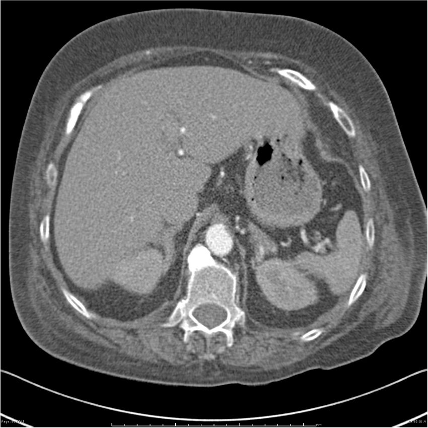 Acute-on-chronic pulmonary emboli (Radiopaedia 27925-28169 C+ CTPA 81).jpg