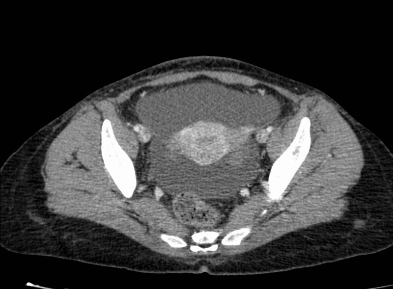 File:Acute Budd-Chiari syndrome (Radiopaedia 60858-68638 Axial C+ portal venous phase 256).jpg