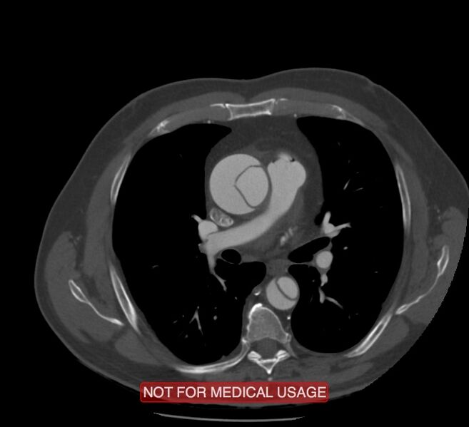File:Acute aortic dissection - Stanford type A (Radiopaedia 40661-43285 Axial C+ arterial phase 27).jpg