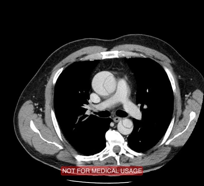 File:Acute aortic dissection - Stanford type A (Radiopaedia 40661-43285 Axial C+ portal venous phase 17).jpg