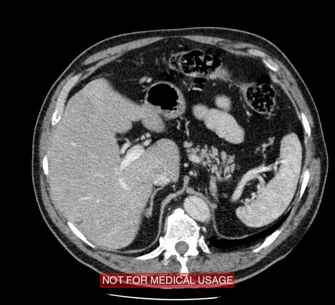 File:Acute aortic dissection - Stanford type A (Radiopaedia 40661-43285 Axial C+ portal venous phase 71).jpg