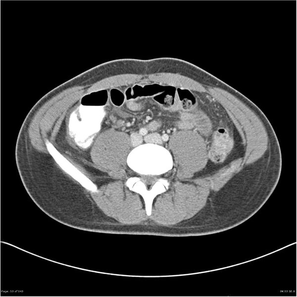 File:Acute appendicitis (Radiopaedia 25364-25615 B 43).jpg