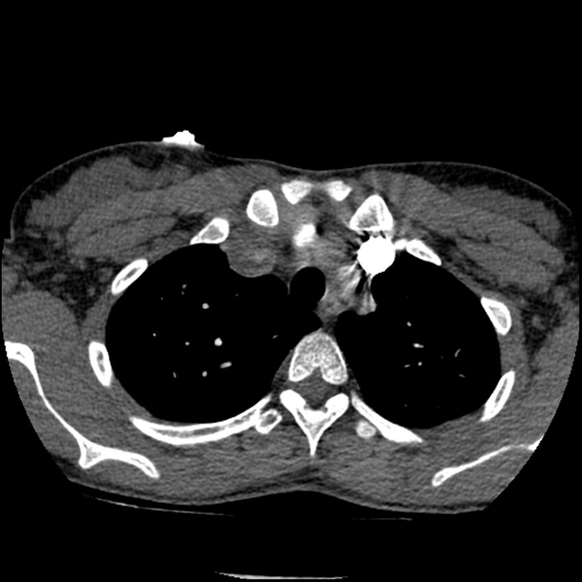 Acute chest syndrome - sickle cell disease (Radiopaedia 42375-45499 Axial C+ CTPA 39).jpg
