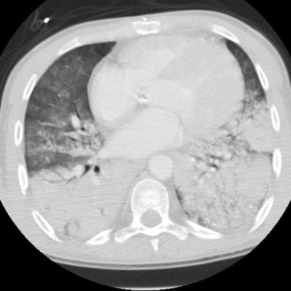 File:Acute diffuse alveolar hemorrhage (Radiopaedia 41323-44158 Axial lung window 37).jpg