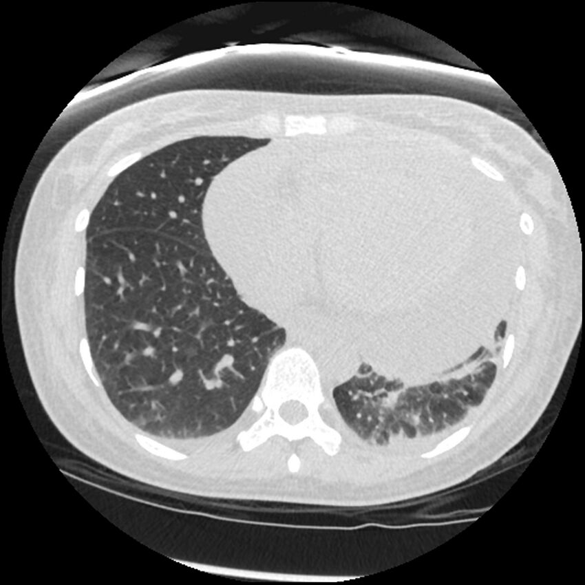 Acute lupus nephritis (Radiopaedia 45832-50107 Axial lung window 68).jpg